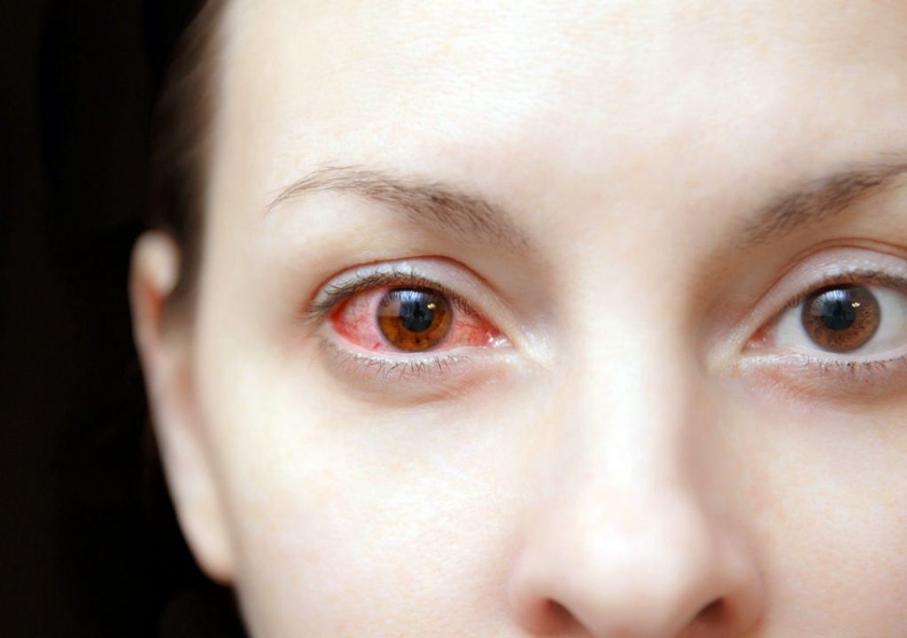 Benar Enggak Sih Sakit Mata Bisa Menular Lewat Tatapan? Begini Jawabannya - GenPI.co SUMSEL