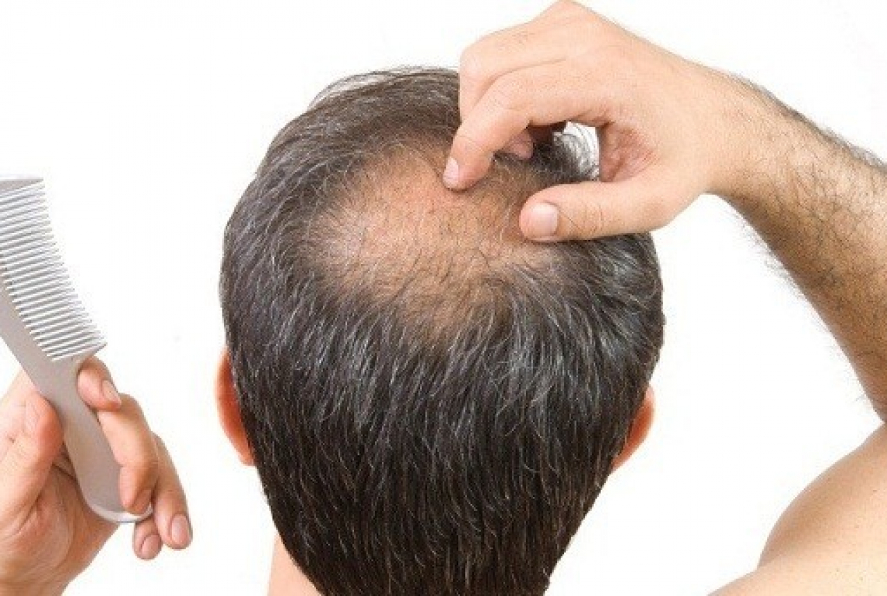 Народные средства от выпадения волос на голове. Выпадение волос у мужчин.