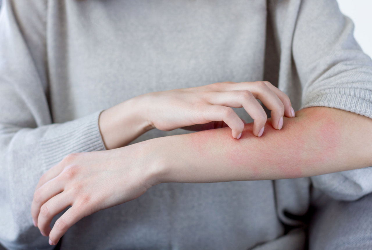 3 Obat Alami Atasi Alergi Dingin, Gatal di Kulit Dijamin Hilang - GenPI.co SUMSEL