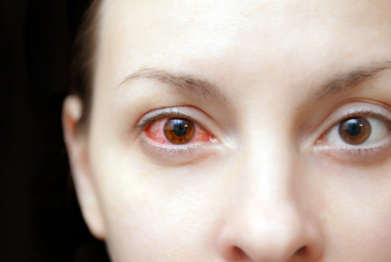 Benar Enggak Sih Sakit Mata Bisa Menular Lewat Tatapan? Begini Jawabannya - GenPI.co SUMSEL