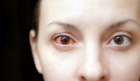 Benar Enggak Sih Sakit Mata Bisa Menular Lewat Tatapan? Begini Jawabannya - GenPI.co Sumsel