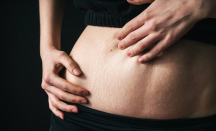 Stretch Mark Dapat Berdampak terhadap Rasa Percaya Diri - GenPI.co