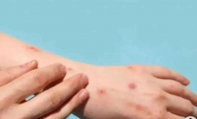 Santri di Meranti Riau Meninggal Diduga Cacar Monyet, 2 Orang Suspek - GenPI.co