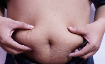 Gaya Hidup Modern Picu Obesitas, Diet Tanpa Pendampingan Tidak Cukup - GenPI.co