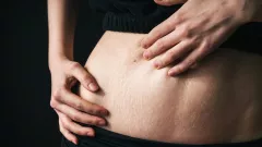 Stretch Mark Dapat Berdampak terhadap Rasa Percaya Diri - GenPI.co