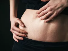 Stretch Mark Dapat Berdampak terhadap Rasa Percaya Diri - GenPI.co