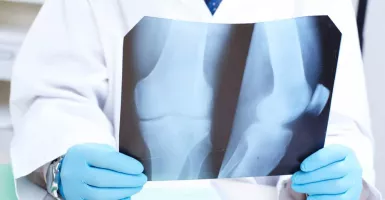 Ternyata Hal Ini Menyebabkan Osteoporosis, Bisa Patah Tulang Lo
