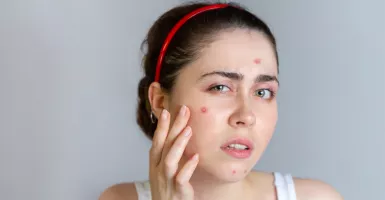 Sebelum Obati Jerawat, Simak 3 Tips Penting Pilih Skincare