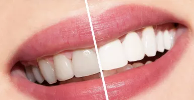 3 Perawatan untuk Memutihkan Gigi yang Wajib Dicoba