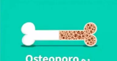 Dokter Tulang Sebut Wanita Rentan Osteoporosis, Mengapa?