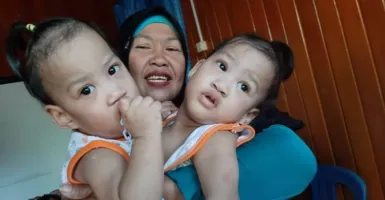 Bayi Kembar Siam Akhirnya Berhasil Dipisahkan Setelah Dioperasi