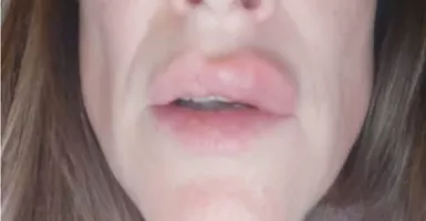 Mengerikan, Bibir Wanita Ini Meledak Setelah Lakukan Filler