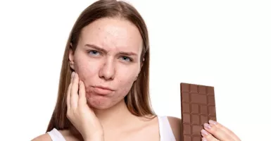 3 Penyebab Timbul Jerawat di Wajah, Nomor 2 Banyak Makan Cokelat