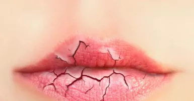 Yuk Cegah Bibir Pecah-Pecah Hanya dengan Melakukan 3 Cara Ini