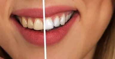 Cara Jitu Putihkan Gigi Dengan Biaya Murah, Gampang Loh...