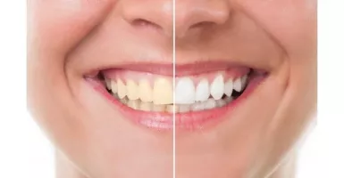 Tak Asal Putih, Simak Saran Dokter Gigi Sebelum Lakukan Veneer