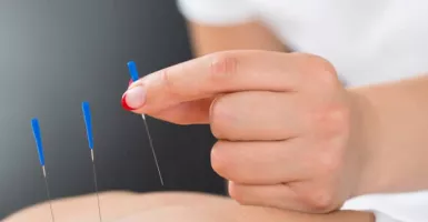 Menjajal Kehebatan Akupunktur untuk Menurunkan Berat Badan
