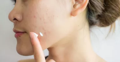 4 Jenis Skin Care Ini Bikin Kulit Wajah Mulus Tanpa Bekas Jerawat