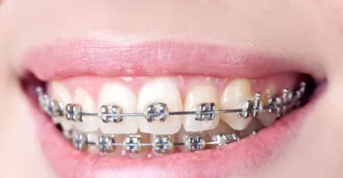 Jangan Asal, Pahami 5 Prosedur Pasang Kawat Gigi