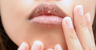 3 Cara Mudah Mengatasi Bibir Pecah-pecah