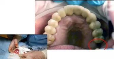 Dokter Pindahkan Gigi Geraham yang ‘Nyasar’ Tumbuh di Testikel