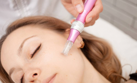 Mengupas Manfaat Microneedling, Langkah Cerdas Menuju Kulit Lebih Mulus - GenPI.co