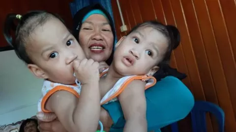Bayi Kembar Siam Akhirnya Berhasil Dipisahkan Setelah Dioperasi - GenPI.co