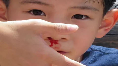 Sakit Kepala Serta Mimisan Banyak Terjadi Pada Anak - GenPI.co