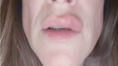 Mengerikan, Bibir Wanita Ini Meledak Setelah Lakukan Filler - GenPI.co