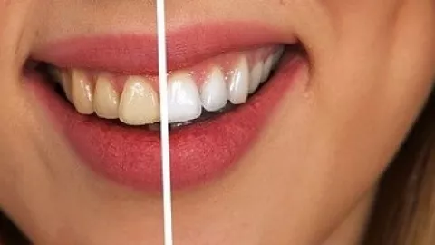 Cara Jitu Putihkan Gigi Dengan Biaya Murah, Gampang Loh... - GenPI.co
