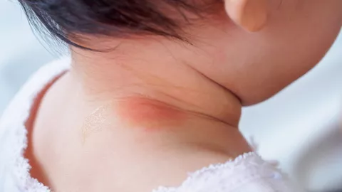Mom, 3 Hal Ini Jadi Penyebab Leher Bayi Merah - GenPI.co