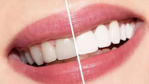 3 Perawatan untuk Memutihkan Gigi yang Wajib Dicoba - GenPI.co
