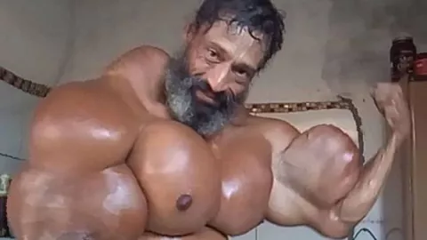 Begini Akhir Hidup Pria Brasil dengan Otot Palsu Hasil Suntikan - GenPI.co