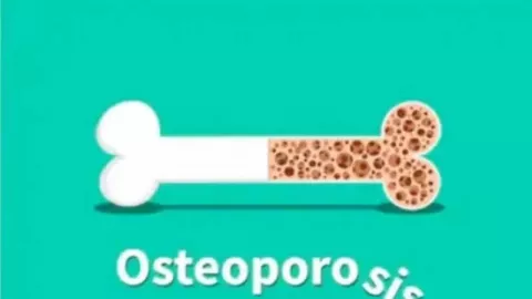 Dokter Tulang Sebut Wanita Rentan Osteoporosis, Mengapa? - GenPI.co BALI