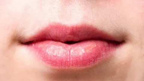 Dokter Kulit: Menjilat Bibir Kering saat Puasa Berdampak Buruk - GenPI.co BALI