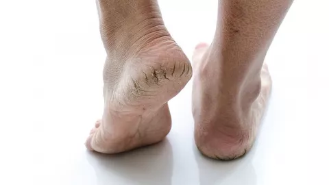 Jangan Dianggap Remeh! 3 Penyebab Tumit Kaki jadi Kering & Pecah - GenPI.co