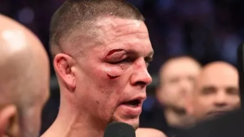 Pemulihan Mata Kanan, Petarung Nate Diaz Harus Istirahat 90 Hari - GenPI.co
