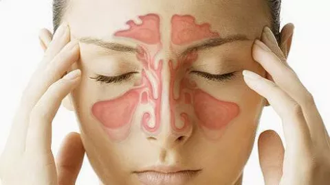 Cara Mengobati Sinus dengan Semprot Hidung hingga Antibiotik - GenPI.co JATENG