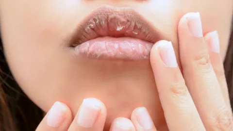 3 Cara Mudah Mengatasi Bibir Pecah-pecah - GenPI.co KALBAR