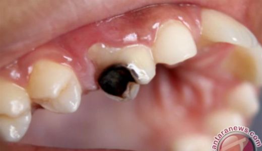 8 Penyebab Paling Umum Gigi Anda Mudah Berlubang, Catat! - GenPI.co SULTRA