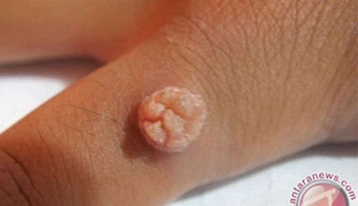 Tumbuh Kutil Mengganggu di Jari Tangan, Begini Cara Menghilangkan - GenPI.co SULTRA