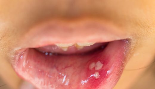 3 Obat Alami Atasi Mulut Sariawan, Dijamin Perih Hilang - GenPI.co SUMSEL