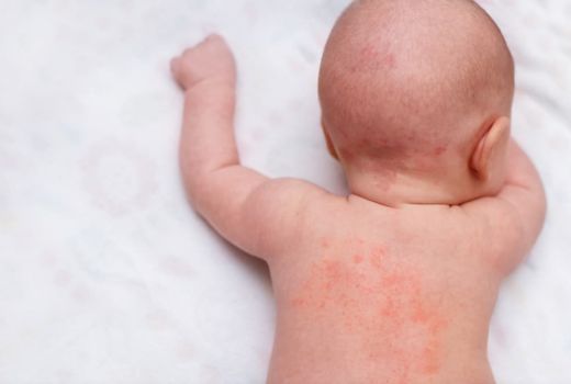 Saat Si Kecil Kena Biang Keringat, Atasi dengan 3 Cara Alami - GenPI.co