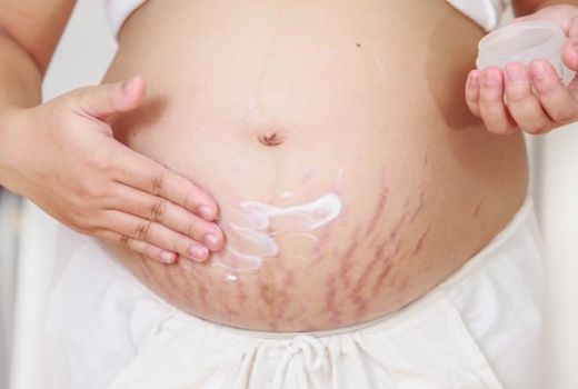 Ladies, Catat Cara Alami Samarkan Stretch Mark pada Lipatan Kulit - GenPI.co