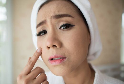 3 Cara Menggunakan Concealer untuk Tutup Noda Bekas Jerawat, Nih Ladies!  - GenPI.co
