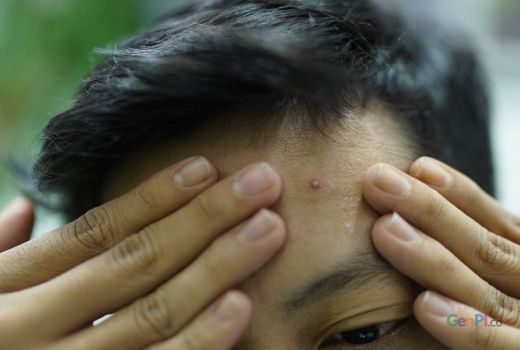 Jangan Sembarangan! Bahaya Memencet Jerawat di Hidung yang Perlu Kamu Tahu - GenPI.co
