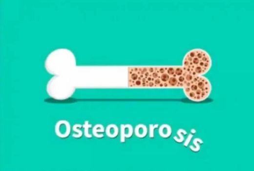 Dokter Tulang Sebut Wanita Rentan Osteoporosis, Mengapa? - GenPI.co BALI