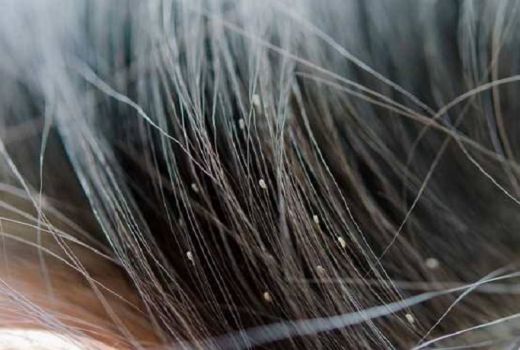 Alkohol Ampuh Basmi Kutu Rambut - GenPI.co