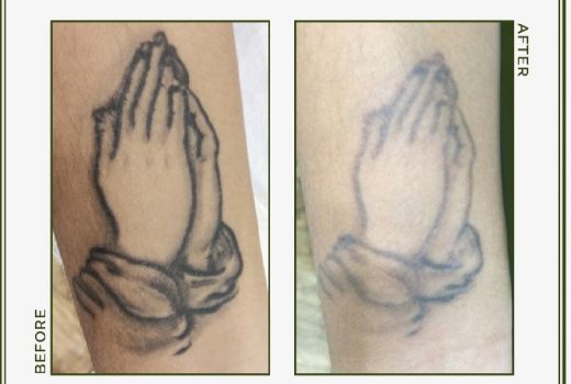 Ingin Hapus Tato di Badan? Begini Saran Dokter Tompi  - GenPI.co