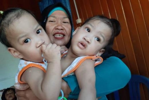 Bayi Kembar Siam Akhirnya Berhasil Dipisahkan Setelah Dioperasi - GenPI.co